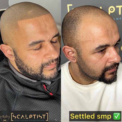 Scalp Micropigmentation Women, Micro Pigmentation, Scalp Tattoo, Bald Men Style, Laser Removal, Scalp Micropigmentation, Hair Tattoo, Skin Scrub, Grey Beards