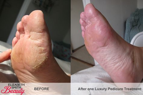 Pedicure Before And After, Vinegar Foot Soak, Deluxe Pedicure, Skin Tags Apple Cider Vinegar, Skin Cream Recipes, Diy Foot Soak, Elizabeth Smith, Skin Hand, Coconut Oil For Skin