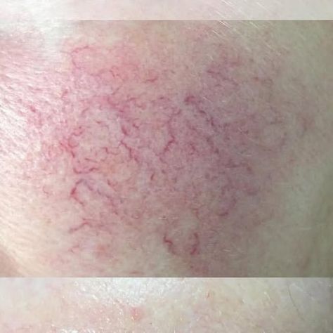 Dr Buddy Paul Beaini on Instagram: "Fotona Laser Face & Leg Vein Treatments Sydney, Wahroonga & Canberra Skin Clinics by MD Cosmedical Solutions - read more on link https://www.mdcosmedical.com.au/face-leg-veins/

#spider #spiderveins #facial #hydrafacial #spa #headspa #lasertreatment #fotonalaser #fotona #veins #capallaries #vein #veintreatment #spiderveinremoval #veinremoval #veinhealth #laser #beauty #skincare #legs #spiderveinstreatment #mdcosmedicalsolutions #drbuddybeaini #skinclinic #fotona #dermatology #medicalspa #laserhairemoval" Fotona Laser, Laser Face, Vein Health, Leg Veins, Vein Removal, Hydra Facial, Skin Clinic, Medical Spa, Beauty Skincare