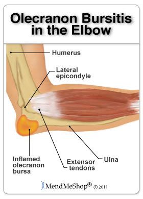 Bursitis is a common cause of elbow pain | MendMeShop Elbow Bursitis, Bursitis Elbow, Cubital Tunnel Syndrome, Tennis Elbow Brace, Golfers Elbow, Soft Tissue Injury, Elbow Braces, Elbow Pain, Braces Colors