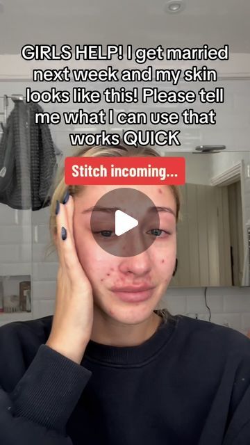 Matt Randon 🧩 on Instagram: "HOW TO GET RID OF BREAKOUTS!😱 (follow for more!💗)

#breakout #breakouts #acnetreatment #acnepositivity #acneproblems #acnetips #skincarejunkie #skincareaddict #skincarelover" How To Get Rid Of Pimples Overnight, Matt Randon, Pimples Overnight, How To Get Rid Of Pimples, Quick Stitch, I Got Married, Follow For More, Got Married, Acne