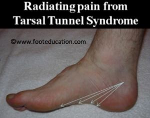 pain occurs because tarsal tunnel syndrome affects the tibial nerve or its branches as they course under tight structures with limited space along the inner Tibial Nerve, Tarsal Tunnel, Nerve Pain Remedies, Nerve Conduction Study, Foot Exercises, Nerve Health, Ankle Pain, Decrease Inflammation, Nerve Pain Relief