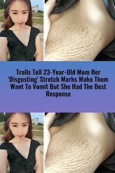 Stretch Mark Removal, Postpartum Body, Good Comebacks, Skin Tissue, Post Pregnancy, Giving Birth, Viral Trend, Child Development, Funny Pins