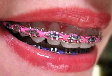 Power chain braces. Find out what are power chains, why your orthodontist uses them to straighten your teeth and what are their benefits. Find out .. Power Chain Braces, Braces Girl, Braces Colors Combinations, Braces Color Wheel, Red Braces, Cute Braces Colors, Kids Braces, Adult Braces, Braces Tips