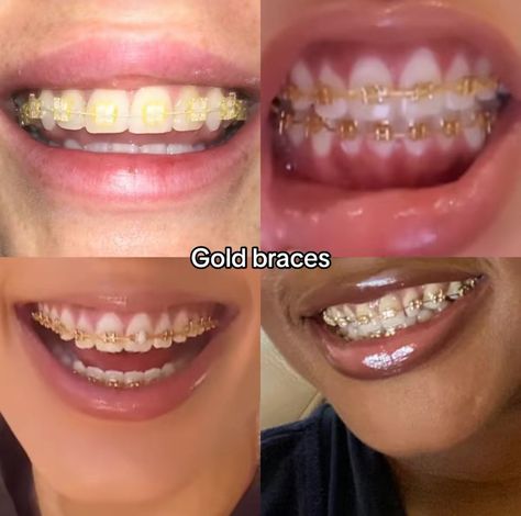 Orange Braces, Perfect Teeth Braces, Power Chain Braces, Pink Braces, Red Braces, Gold Braces, Cute Braces Colors, Pretty Teeth, Grillz Teeth