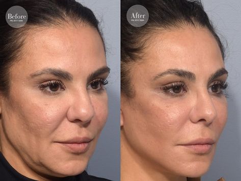 Face Dermal, Thread Lift Face, Facelift Before And After, Facelift Procedure, Aesthetic Surgery, Face Fillers, Face Lift Surgery, Instant Face Lift, Facial Plastic Surgery