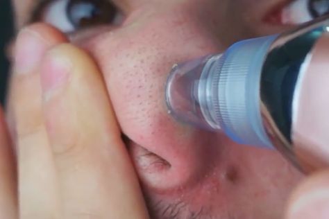 We Bet You Can’t Look Away From This Video of a Blackhead Vacuum Sucking All the Nasty Stuff out of Someone's Face! Pore Vacuum Videos, Facial Steps, Pore Vacuum, Blackhead Extraction, Blackhead Vacuum, Pore Cleaner, Holistic Diet, Remove Blackheads, Facial Cleaning