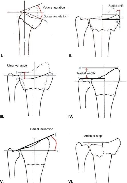 Wrist Fracture, Types Of Fractures, Radiology Tech, Bone Fracture, Observational Study, Human Body Anatomy, Meta Analysis, Elderly People, Body Anatomy