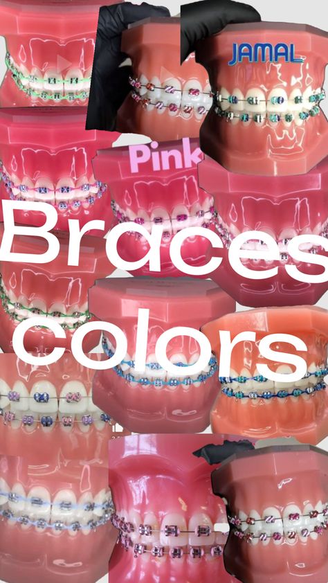 Fall Braces Colors, Braces Colors Combinations, Pink Braces, Cute Braces Colors, Braces Tips, Getting Braces, Cute Braces, Brace Face, Braces Colors