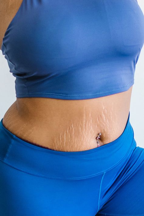 Stretch marks are common in the majority of women. We look at 5 effective ways on how to hide stretch marks on your stomach and minimize them over time. Stretch Mark Remedies, Emotional Eater, Healthy Heart Tips, Marks Cream, Chesty Cough, Skip Breakfast, Losing 40 Pounds, Stretch Mark Removal, Stretch Mark Cream