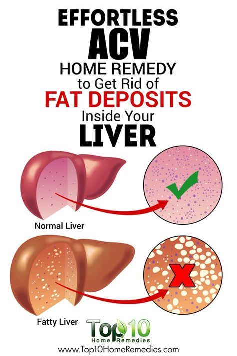 Effortless ACV #Home #Remedy to Get Rid of Fat Deposits Inside Your Liver Top 10 Home Remedies, Detox Your Liver, Liver Diet, Cholesterol Remedies, Overnight Oat, Holistic Remedies, Liver Detox, Healthy Liver, Natural Therapy