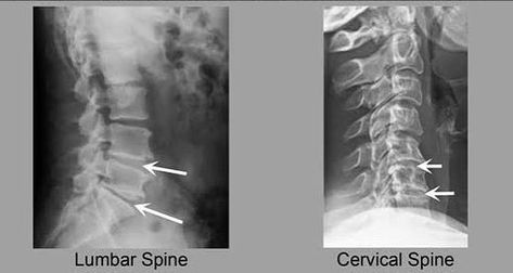 How to STOP Disc Degenerative "Disease" (Exercises & Tips) Best Love Handle Workout, Clean Arteries, Decompression Therapy, Lumbar Disc, Intervertebral Disc, Spinal Decompression, Chronic Lower Back Pain, Disk Herniation, Vibration Plate