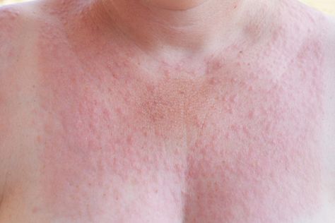 Sun poisoning: Here's what you need to know about the brutal allergy Sun Poisoning Rash, Sun Poisoning, Body Rash, Rash Causes, Sun Allergy, Itchy Rash, Sun Protective Clothing, Best Tan, Going Viral