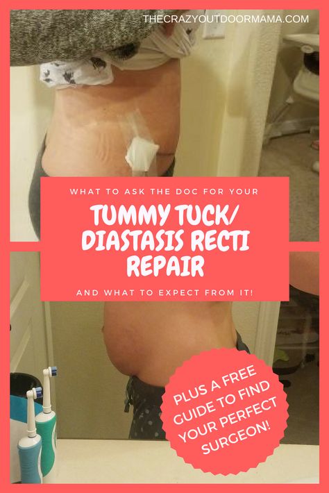 Diastasis Recti Repair, Tummy Tucks Recovery, Mommy Makeover Surgery, K Tape, Diastasis Recti Exercises, Abdominal Surgery, Mommy Makeover, Diastasis Recti, Surgery Recovery