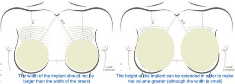 Round vs Teardrop Implant Round Implants, Teardrop Implants, Teardrop Vs Round Implant, Breast Implant Sizes Before After, Breast Implant Removal, Moderate Profile Breast Implants, Breast Augmentation, Plastic Surgery, Surgery