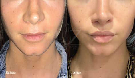 upper lip lift orlando, what is an upper lip lift, upper lip lift surgery, hz plastic surgery Corner Lip Lift, Lip Lift Surgery Before And After, Lip Lift Before And After, Lip Filler On Small Lips, Lip Plastic Surgery, Lip Lift Surgery, Round Lips, Upper Lip Lift, Surgery Inspiration