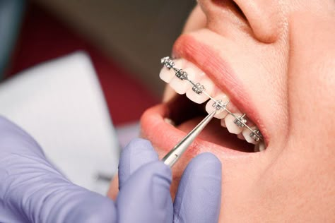 If you're unfamiliar with the process of getting braces, it will be beneficial to take a few moments to learn the overview of the process and what you can expect. Lingual Braces, Braces Cost, Types Of Braces, Adult Braces, Getting Braces, Clear Braces, Braces Colors, Teeth Straightening, Teeth Braces