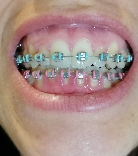 Teal And Pink Braces, Teal Braces, Braces Ideas, Pink Braces, Teal And Pink, Braces, Savannah, Savannah Chat, Pasta