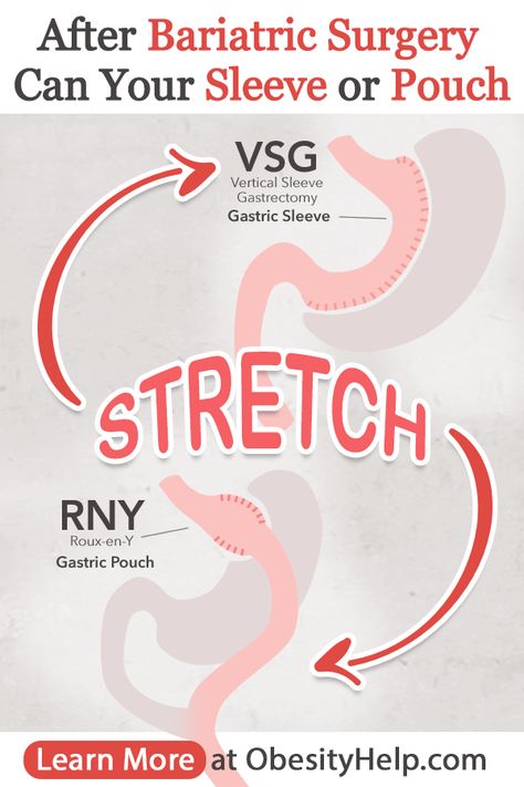 There are so many questions after Bariatric Surgery! Does the gastric pouch or gastric sleeve stretch after bariatric surgery? Does the size of a pouch determine the results? Will there be weight regain associated with stomach stretching? Learn more about pouch size, stomach stretching, and hormones! #VSG #RNY #BariatricSurgery #WLS Gastric Bypass Stomach Reset, Vsg Pouch Reset Diet, Stomach Reset, Pouch Reset Diet, Bariatric Nutrition, Rny Recipes, Stomach Stretches, Pouch Reset, Gastric Surgery