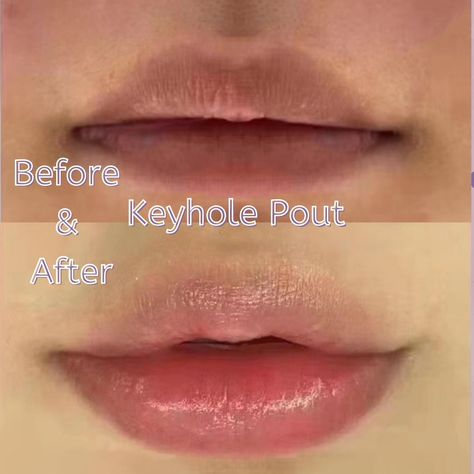 Kendall, Angelina, Scarlett Johansson, And Gigi Hadid has it! It’s the “keyhole Pout,” It’s very sexy but in a very subtle way! Keyhole Pout Lip Filler, Pout Lip Filler, Keyhole Lips, Pdo Threads, Led Facial Mask, Led Facial, Derma Pen, Medical Aesthetics, Ipl Hair Removal