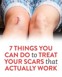 7 Things You Can Do To Treat Your Scars That Actually Work Scar Healing Remedies, Getting Rid Of Scars, Scar Remedies, How To Fade, Camp Counselor, Jungle Gym, Scooter Bike, Weight Workout, Raise Your Hand If