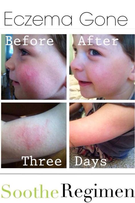 SOOTHE for eczema, psoriasis, rash, razor burn, bug bites, poison ivy, sensitive skin... Get it here:  www.lydiabuckler.myrandf.com Roden And Fields, Rodan And Fields Soothe, Rodan Fields Skin Care, Sensitive Skincare, Field Marketing, Rodan And Fields Business, Rodan And Fields Consultant, Life Changing Skincare, Skincare Regimen