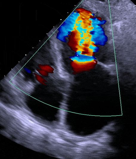 Echocardiogram vs. EKG – Explained By A Cardiologist • MyHeart Coarctation Of The Aorta, Heart Catheterization, Cardiac Sonography, Fast Heart Rate, Heart Structure, Sonography Student, Abdominal Aorta, Heart Echo, Hospital Admit