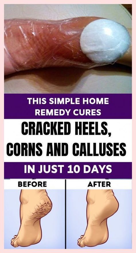 Commendable info! Skin Itching, Unhealthy Diet, Cracked Heels, Health And Fitness Articles, Cracked Skin, Peeling Skin, Homemade Remedies, Diy Beauty Hacks, Simple House