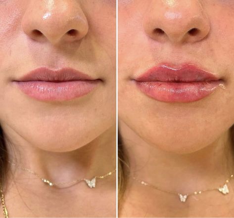 Facial Balancing, Face Injections, Dermal Fillers Lips, Lip Flip, Lips Inspiration, Face Fillers, Botox Before And After, Botox Lips, Facial Fillers