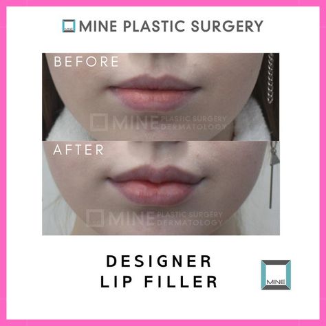 Lip Filler Korea, Korean Lip Filler Before And After, Korean Cherry Lips Filler, Wonyoung Lip Filler, Korean Lip Filler, Lip Flip, Lip Surgery, Chin Filler, Korean Lips