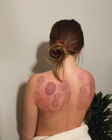 Massage Corp. on Instagram: "POST TX CUPPING MARKS Cupping marks are different for everyone and can vary in colour and time present. They fade anywhere from 24 hours up to 14 days depending on the individual • • • • • #cupping #myofascialrelease #myofascial #cuppingtherapy #massagetherapy #mobilemassage #massagecorp #naturalhealing #wellness #wellbeing #yyc #calgary #calgarylifestyle #smallbusiness #branding #marketing #foryoupage" Cupping Therapy Aesthetic, Cupping Aesthetic, Hijama Cupping Therapy, Benefits Of Cupping, Massage Images, Massage Pictures, Fire Cupping, Mobile Massage, Cupping Massage