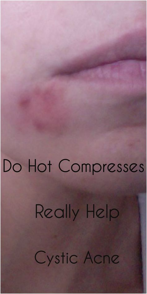 Read my personal experience with hot compression's and how it can affect cystic acne. Hot Compress, Cystic Acne, Cider Vinegar, Apple Cider Vinegar, Beautiful Skin, Apple Cider, Vinegar, Cider, Things To Do