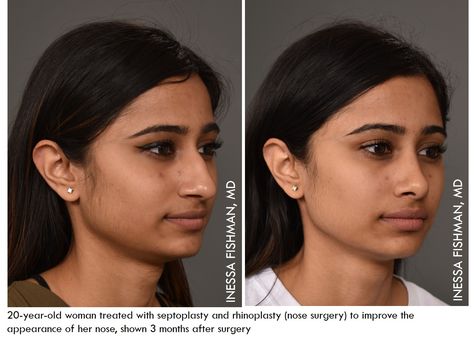 Rhinoplasty, or nose surgery, is one of our most favorite procedures--both for its exacting demands and artistry. This 20-year-old, beautiful patient wanted to improve the appearance of her nose, and Dr. Inessa Fishman treated her with a septoplasty and rhinoplasty to smooth her nasal bridge and recontour her nasal tip. She is shown 3 months after surgery, with a natural-looking nose that will continue to improve in its appearance as swelling resolves over the next few months. Nose Goals, Nose Ideas, Jawline Goals, Nose Plastic Surgery, Nose Surgery Rhinoplasty, Makeup Collage, Bulbous Nose, Nose Jobs, Rhinoplasty Nose Jobs