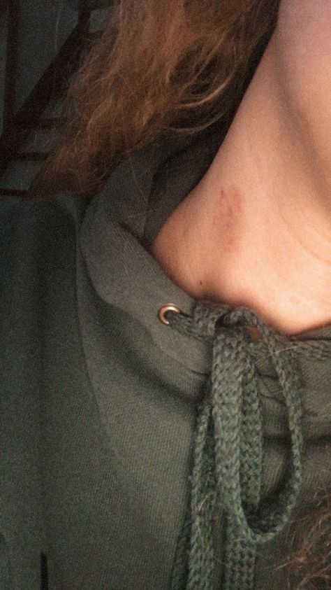 Cute Hickies Neck, Hickys Neck Aesthetic, Hicks On Neck Girl, Hickies Neck Girl, Chest Love Bites Hickey, Hickey Girls, Love Bite Photos Couples, Love Bites Aesthetic, Hickies Girl