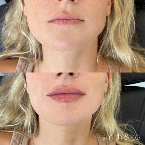 Natural Lip Fillers, Cupids Bow Lips, Thick Lips, Lip Lift, Heart Shaped Lips, Lips Inspiration, Botox Filler, Botox Lips, Facial Fillers