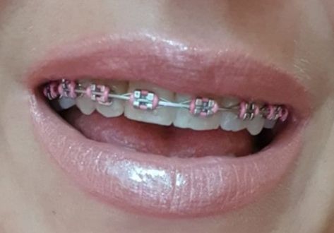 Baby Pink Braces, Light Pink Braces, Braces Pink, Perfect Teeth Braces, Oikawa Kinnie, Brace Ideas, Pink Braces, Cute Braces Colors, Teeth Aesthetic