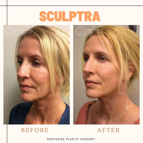 Facial Swelling, Sculptra Aesthetic, Liquid Facelift, Face Lift Surgery, Wrinkle Filler, Facial Tissues, Facial Aesthetics, Botox Fillers, Under The Skin