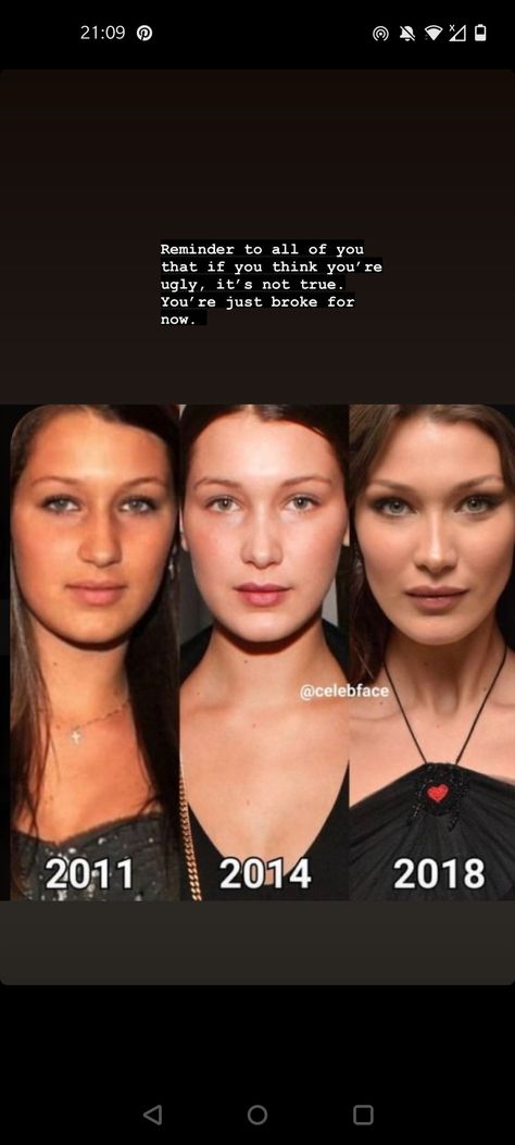 Plastic surgery changed beauty standards but also made them a bit more attainable ? What do you think of Bella Hadid's transformation ? Plastic Surgery Transformation, Bella Hadid Weight Before After, Bella Hadid Before And After Surgery, Bella Hadid Before Surgeries, European Beauty Standards, Bella Hadid Surgery, Bella Hadid Skincare, Acne Transformation, Plastic Surgery Aesthetic