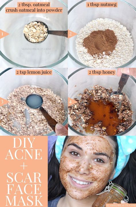 This DIY face mask for acne & scars uses honey and nutmeg to help clear pimples and lighten acne scars. It's easy to make with pantry ingredients! Diy Face Mask For Acne, Face Mask For Dry Skin, Clear Pimples, Acne Scar Diy, Face Mask For Acne, Best Diy Face Mask, Acne Scar Mask, Mask For Acne, How To Clear Pimples