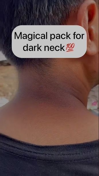 Remove Neck Darkness, Dark Skin Around Neck, Dark Neck Remedies, Remedies For Hyperpigmentation, Hyperpigmentation Remedies, Dark Neck, Dark Spots Remedies, Face And Body Care, Homemade Garden