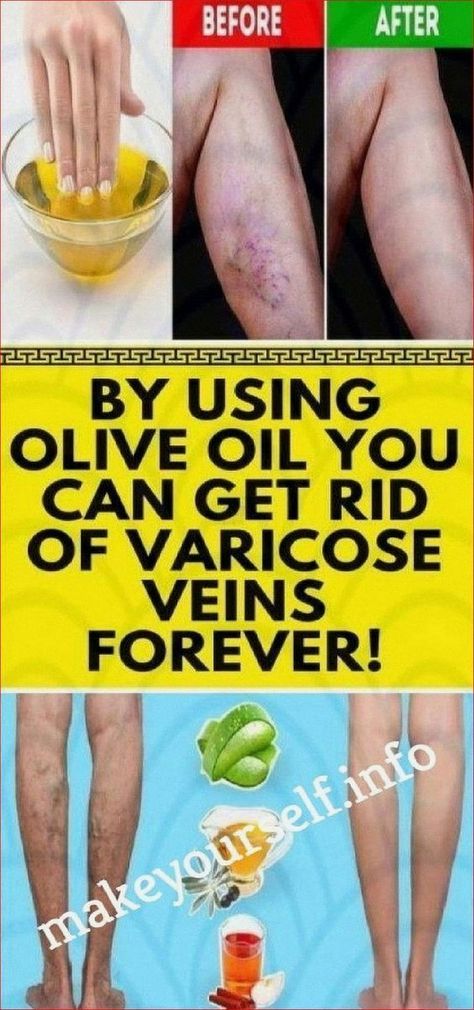 How To Remove Varicose Veins Using The Magic of Olive Oil Cloves Health Benefits, Home Remedies For Allergies, Varicose Vein Removal, Varicose Vein Remedy, Natural Remedies For Migraines, Dry Skin Remedies, Medical School Essentials, Herbs For Health, Natural Remedy