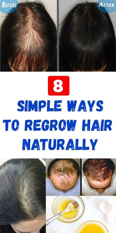 8 Tips to Naturally Regrow Your Hair Faster How To Regrow Hair, Regrow Hair Naturally, Hairfall Treatment, Hair Growing Tips, Hair Remedies For Growth, Home Remedies For Hair, Regrow Hair, Grow Long Hair, New Hair Growth