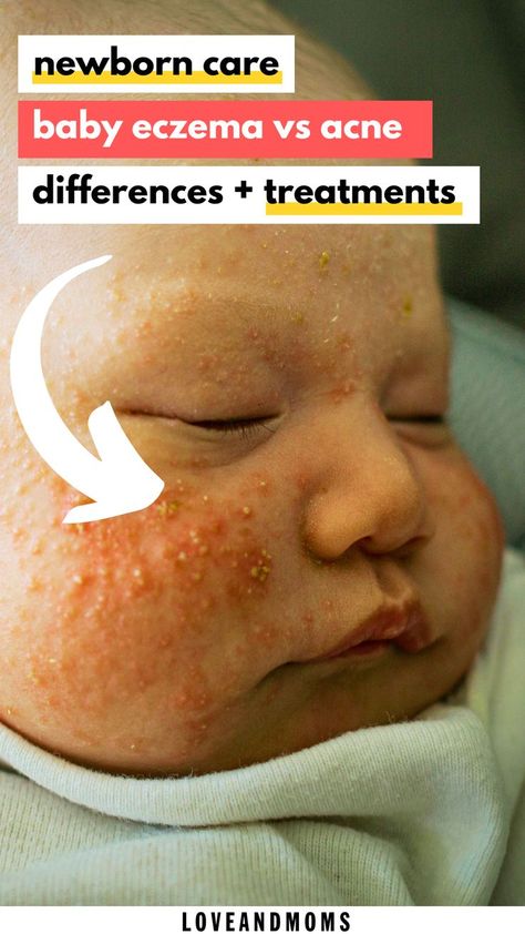 baby acne Newborn Rash On Face, Baby Acne Remedy Breastmilk, Baby Acne Remedy How To Get Rid Of, Baby Excema, Newborn Skin Peeling, Newborn Dry Skin, Baby Acne Remedy, Newborn Acne, Acne Home Remedies