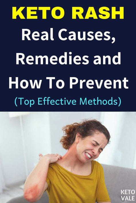 Keto Rash: Causes and Remedies Face Rash Remedies How To Get Rid, Rash On Stomach, Essential Oils For Rash And Itching, Keto Rash, Itchy Rash, Keto Shopping List, Keto Dinner, Health Advice, Diet Tips