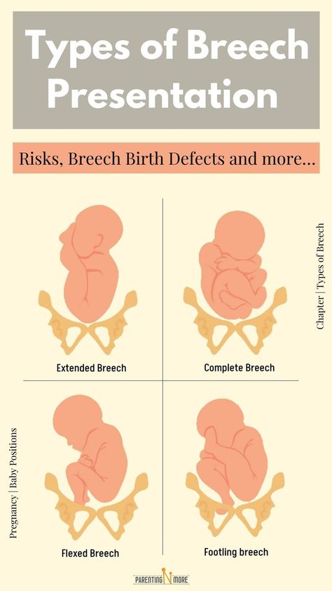 Know types of breech presentation along with detailed explanation on Breech definition. Article also throws light on risks involved and possible birth defects Ecv Procedure, Turn A Breech Baby, Breech Birth, Breech Baby, Breech Babies, Birth Delivery, Doula Care, Nclex Study Guide, Birth Education