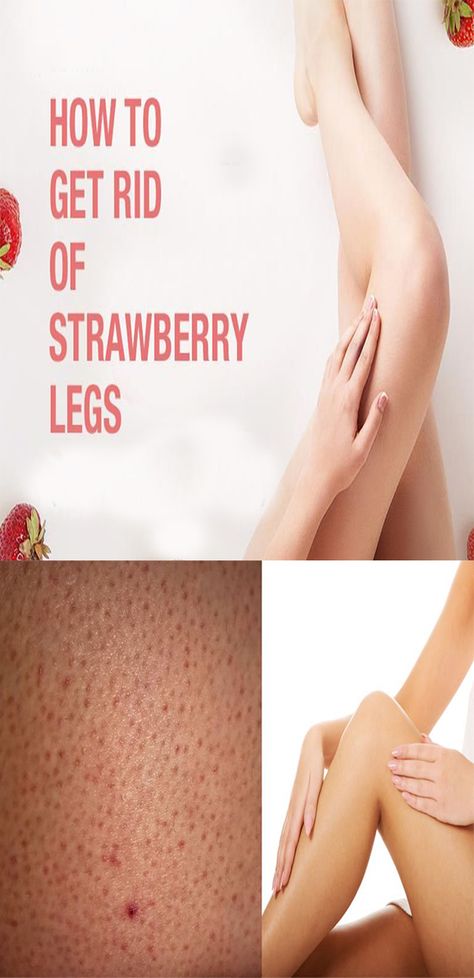 Strawberry Hands Remedy, Strawberry Legs Remedy How To Get Rid, Strawberry Legs Remedy, Legs At Home, Strawberry Legs, Hand And Foot Care, Natural Face Mask, Razor Burns, Healthy Glowing Skin