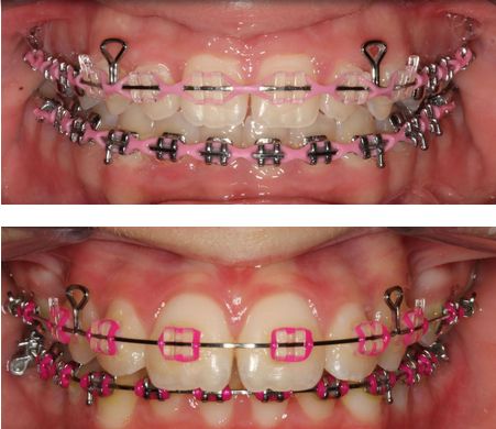 Braces Pink Bands, Clear Braces With Color Bands, Gray Braces, Grey Braces, Power Chains, Transparent Braces, Rainbow Braces, Braces Colours, Dental Braces Colors