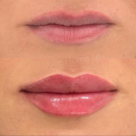 Facial Aesthetics 🇬🇧 on Instagram: “Perfectly natural results with 1ml lip filler 😍👄 Do you like the results?🤔👇 Via @juliehornelips ⤵️ Follow @botoxnfillers for more 💉 🤔Chin…” Lip Fillers Juvederm, 1ml Lip Filler, Restylane Lips, Lip Permanent Makeup, Lips Inspiration, Permanente Make-up, Face Fillers, Botox Lips, Aesthetic Dermatology