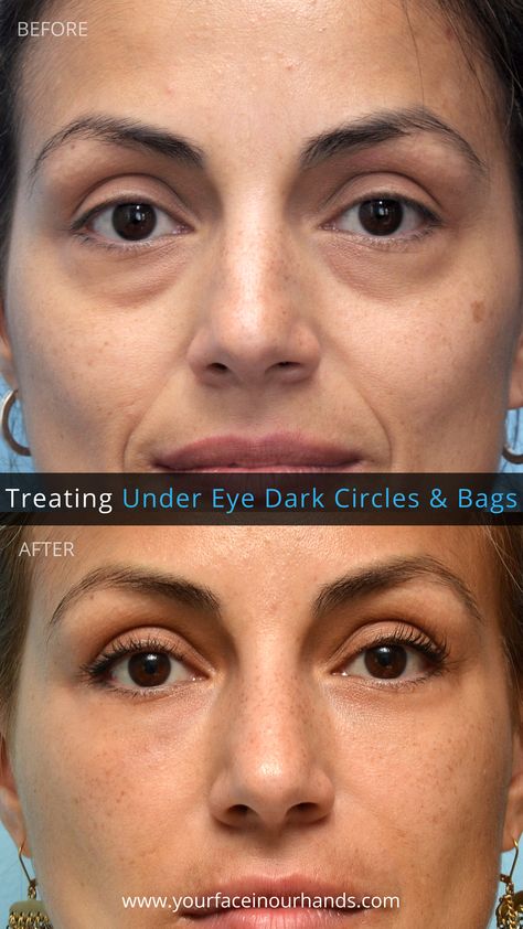 How To Get Rid Of Tear Troughs, Eye Trough Filler, Noise Job, Under Eye Filler Before And After, Eye Lift Surgery, Cosmetic Fillers, Under Eye Fillers, Face Fillers, Downtown San Francisco