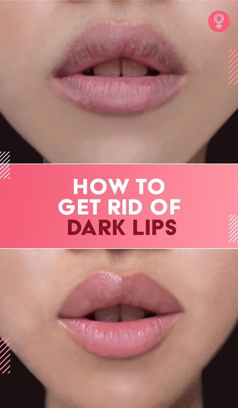 How To Get Rid Of Dark Lips: It is a known fact that everyone is born with a different shade and color of lips, but issues arise when hyperpigmentation occurs. Thus, it is important to recognize the cause and then go for treatments that work well to get rid of dark lips. Lighten Dark Lips, Softer Lips, Natural Pink Lips, Coconut Oil Coffee, Natural Face Skin Care, Dark Underarms, Dry Skin Remedies, Purple Lips, Home Remedies For Hair